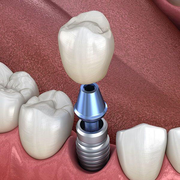 Dental implant components displayed on burgundy fabric: crown, abutment, and fixture models.