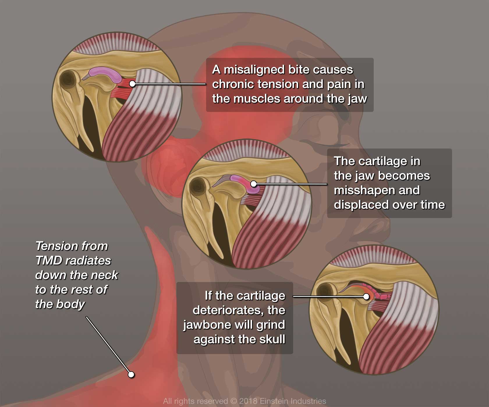 Anatomical diagrams showing jaw structure and TMJ disorder progression with muscle inflammation and cartilage damage.