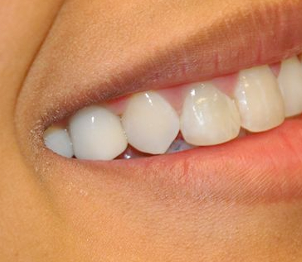 Close-up of a person's smile displaying bright, white, healthy teeth and gums.