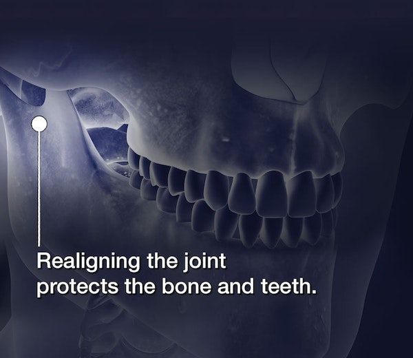X-ray of skull showing jaw joint alignment with text about bone and teeth protection.