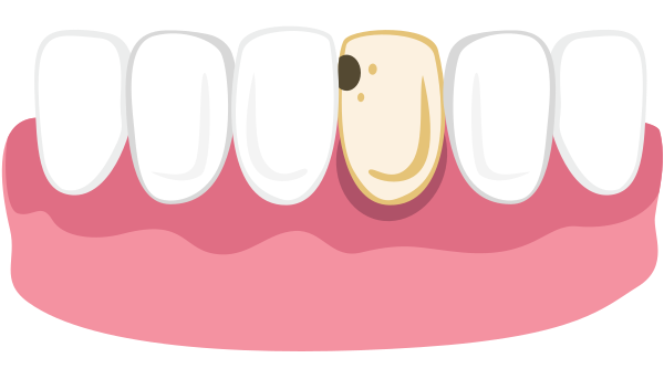 Dental implant illustration showing artificial tooth crown placement in gum model among natural teeth.
