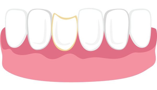 Illustration of six white teeth with pink gums showing dental spacing and alignment.