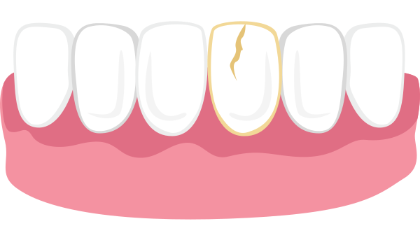 Illustration of six teeth with one cracked tooth and pink gum tissue below.
