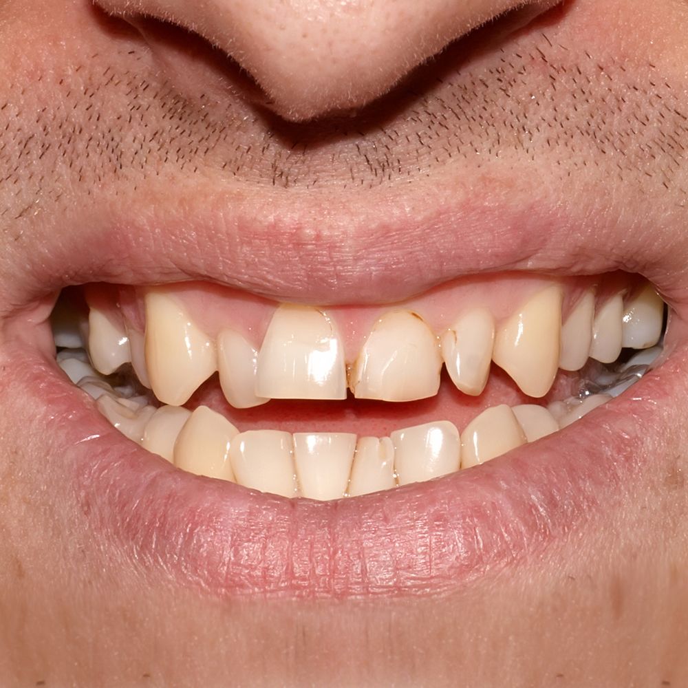 Close-up of person's smile showing teeth with visible gaps and discoloration, demonstrating dental concerns.