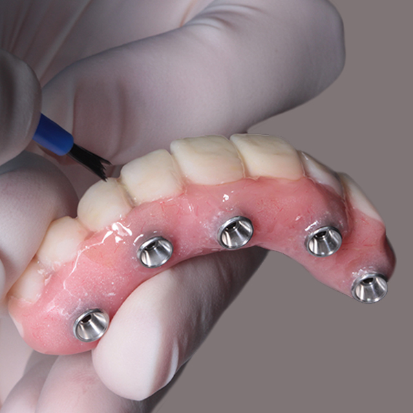Dental professional holding implant-supported denture with metal attachment posts for examination.