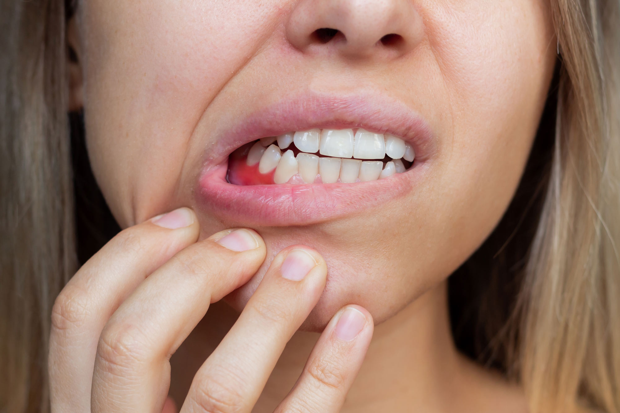 Woman pointing to mouth showing gum inflammation and dental health concern.