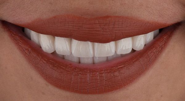 Close-up of a bright, healthy smile showing white teeth and natural lip color