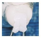 Dentist's gloved hands holding dental mirror during oral examination procedure