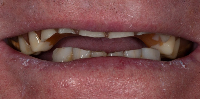 Close-up of teeth showing discoloration and decay, dental health example.