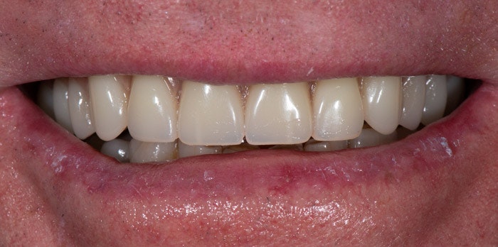 Close-up of upper teeth showing dental work and natural tooth coloring in smile.