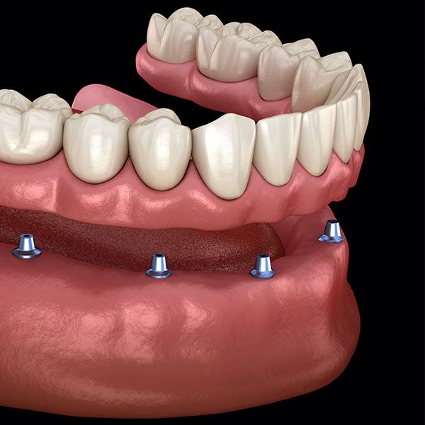 3D dental implant model showing prosthetic teeth on implant posts in jawbone.